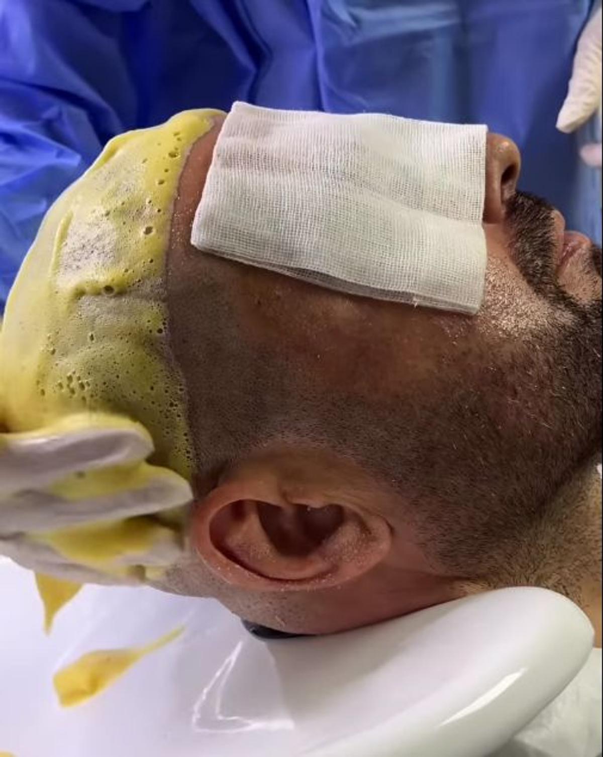 Adrian Mutu și-a făcut implant de păr