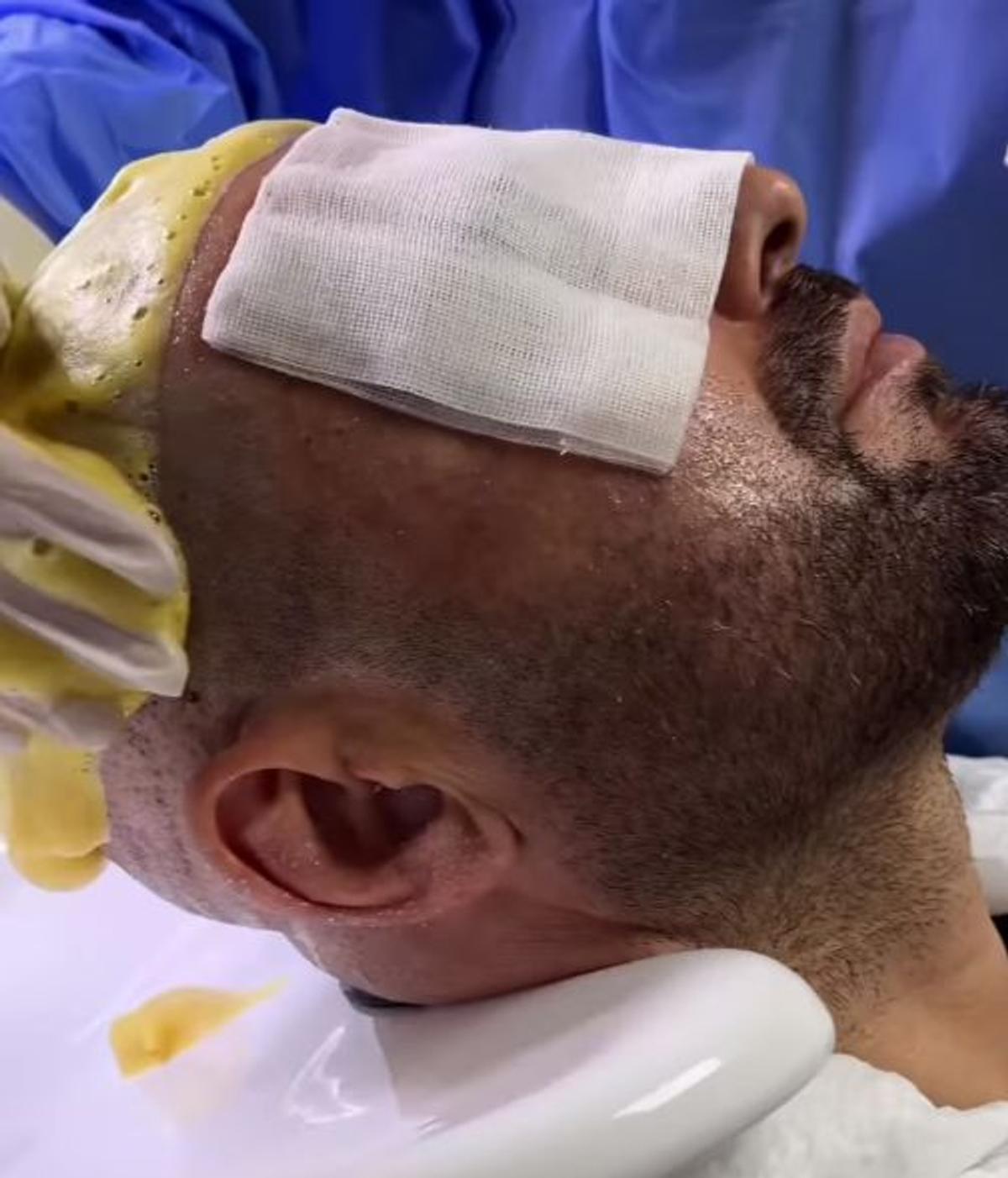 Adrian Mutu și-a făcut implant de păr