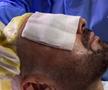 Adrian Mutu și-a făcut implant de păr