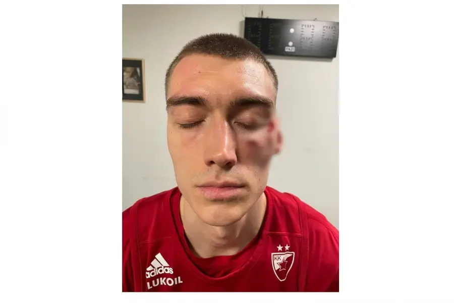 Stefan Lazarevic's injury/Photo: FK Crvena zvezda Scene scandaloase înaintea derby-ului de diseară » Jucătorii s-au luat la bătaie la vestiare! Se cere intervenția Ministerului de Interne: „Vătămare corporală gravă!