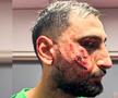 Așa arăta fața lui Gianluigi Donnarumma la scurt timp după lovitura primită // sursă foto: RMC SPORT