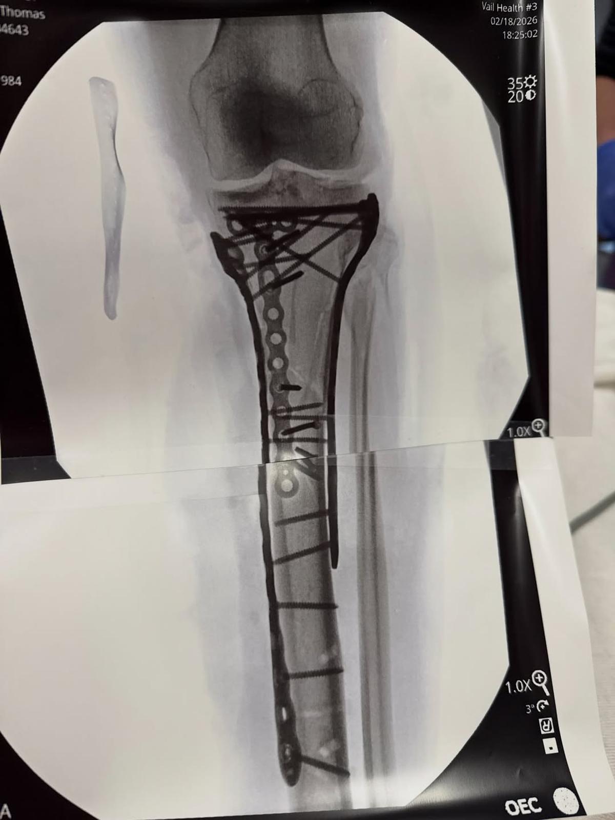 Lindsey Vonn după a cincea operație