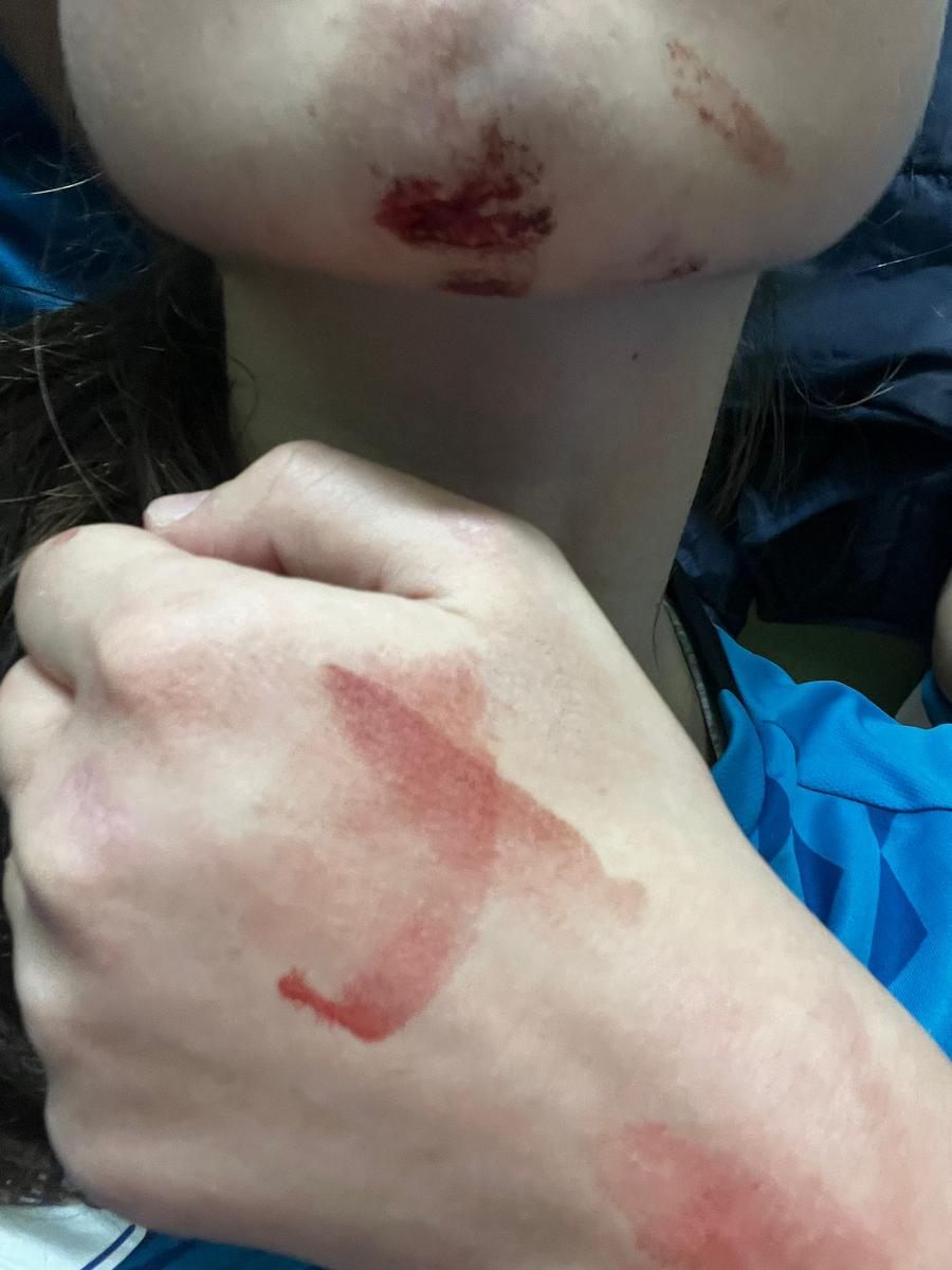 Așa arăta jucătoarea accidentată Sânge, spectatori în teren și cartonașe roșii în handbalul juvenil românesc!