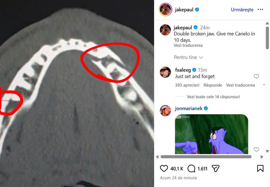 Jake Paul a publicat radiografia și a glumit: „Aduceți-mi-l pe Canelo în 10 zile” KO în runda 6! Anthony Joshua i-a făcut o fractură dublă de mandibulă lui Jake Paul, în lupta de 200 de milioane $