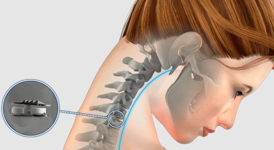 Mobi-C este o proteză (implant) cervicală artificială destinată înlocuirii discului intervertebral degenerat în zona vertebrelor C3-C7 Doctorul-preot care l-a operat pe Gigi Becali, în mijlocul unor acuzații grave: malpraxis și metode controversate