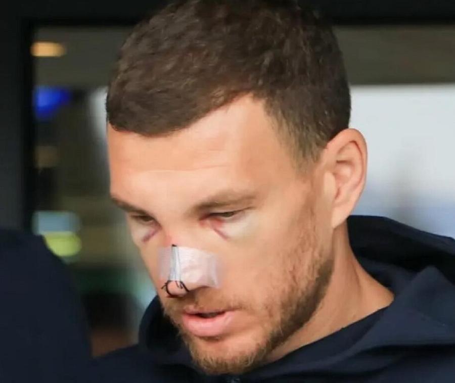 Edin Dzeko, apariție șocantă după ce Mihai Popescu i-a dat un șut în față. Mario Balotelli a intervenit