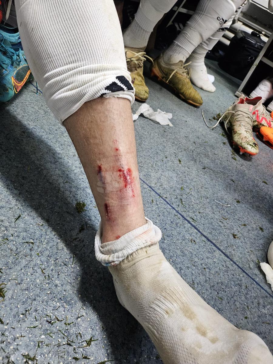 Dinamo recidivează: imagine-șoc cu Romario Benzar după intrarea criminală a lui Abdallah » Diagnosticul pus la spital