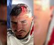 Dinamo recidivează: imagine-șoc cu Romario Benzar după intrarea criminală a lui Abdallah » Diagnosticul pus la spital
