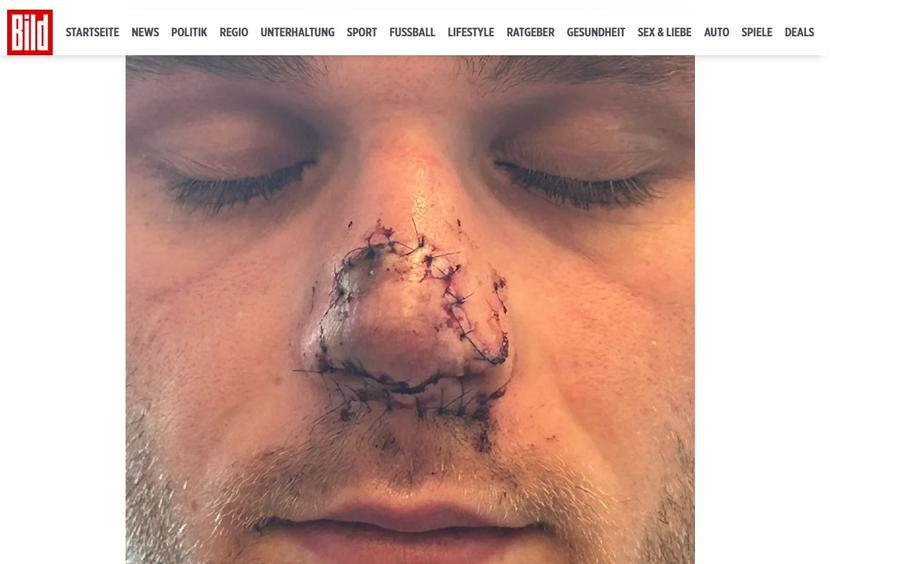 Horror! Arbitrul i-a găsit nasul pe gheață și la spital i l-au prins la loc cu 25 de copci