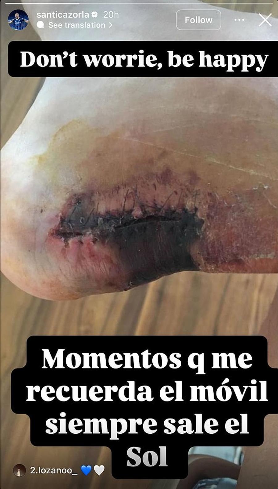 Așa a arătat la un moment dat tendonul lui Santi Cazorla Fotografie cu puternic impact emoțional! Rana din cauza căreia un internațional era să-și piardă piciorul