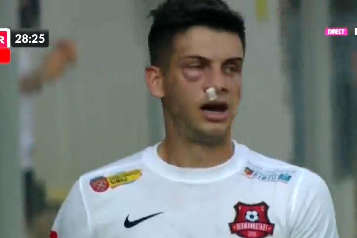 Atenție, imagini dure în Liga 1: hemoragie nazală și hematom pronunțat după o lovitură nesancționată de arbitri