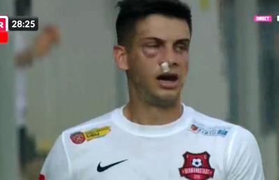 Atenție, imagini dure în Liga 1: hemoragie nazală și hematom pronunțat după o lovitură nesancționată de arbitri