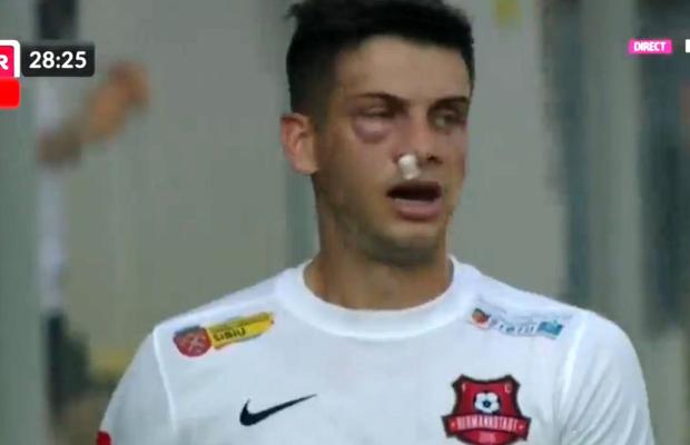Atenție, imagini dure în Liga 1: hemoragie nazală și hematom pronunțat după o lovitură nesancționată de arbitri