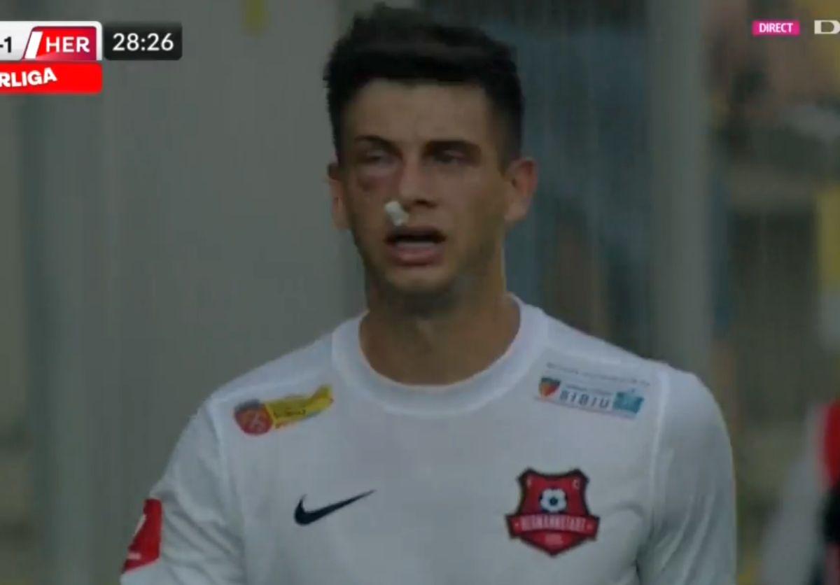 Atenție, imagini dure în Liga 1: hemoragie nazală și hematom pronunțat după o lovitură nesancționată de arbitri