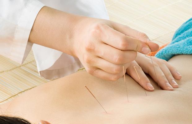 Descoperă puterea acupuncturii: Cum poate îmbunătăți sănătatea și starea de bine