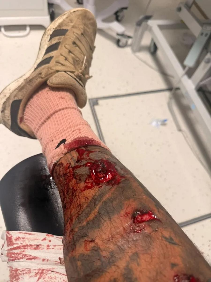 Rănile produse de câinele care l-a atacat pe Jermaine Pennant Atacat de un câine în timp ce-și plimba câinele » Fosta vedetă din Premier League a avut nevoie de 50 de copci