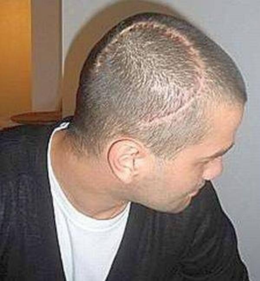 Așa arăta capul lui Chivu după operația de refacere a craniului din 2010 Cristi Chivu, dezvăluire cutremurătoare: „A trebuit să fac un transplant de la un cadavru” + Ce ar cere unui club din România ca să vină antrenor