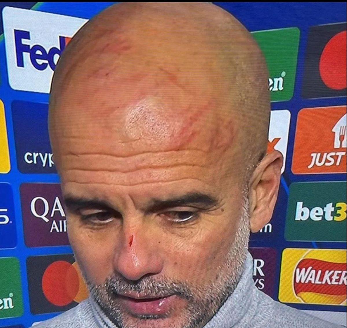 Pep Guardiola s-a însângerat la meciul din Liga Campionilor