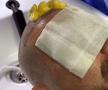 Adrian Mutu și-a făcut implant de păr