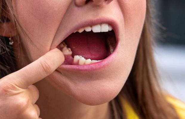 Impactul lipsei dinților asupra sănătății generale: Riscurile bacteriemiei
