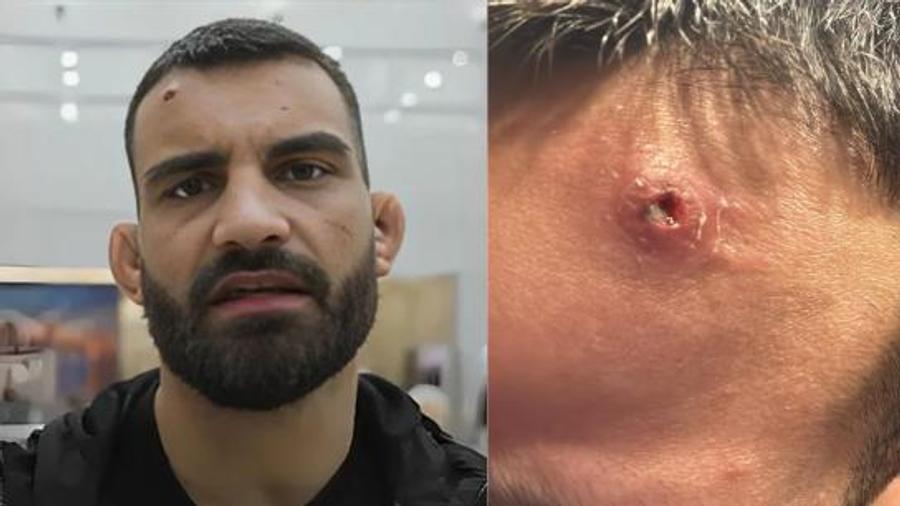 Benoit Saint Denis, o altă victimă a „pandemiei tăcute” cu stafilococ auriu din UFC „Pandemia tăcută” din UFC face ravagii » Inclusiv Merab Dvalishvili, campionul categoriei „cocoș”, a avut de suferit! Toți din fenomen sunt expuși