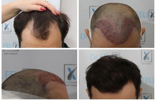 Află de aici de un implant de păr la clinică, Dr Felix Hair Implant te ajută în acest sens