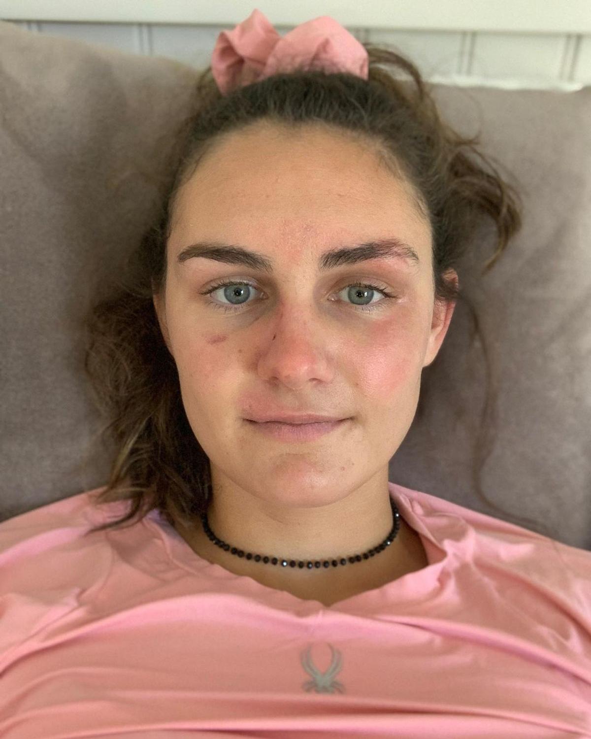 Vindecare în timp record » Cum arată acum Alice Merryweather, schioarea accidentată grav în urmă cu 3 săptămâni. Atenție, imagini dure!