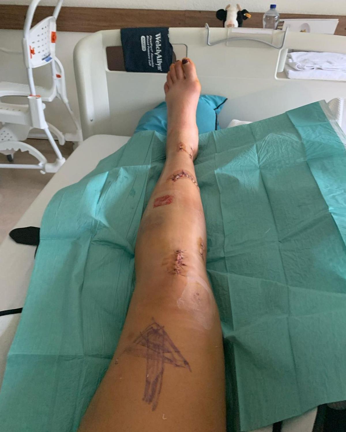 Vindecare în timp record » Cum arată acum Alice Merryweather, schioarea accidentată grav în urmă cu 3 săptămâni. Atenție, imagini dure!