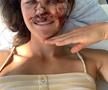 Vindecare în timp record » Cum arată acum Alice Merryweather, schioarea accidentată grav în urmă cu 3 săptămâni. Atenție, imagini dure!
