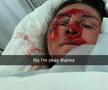 Vindecare în timp record » Cum arată acum Alice Merryweather, schioarea accidentată grav în urmă cu 3 săptămâni. Atenție, imagini dure!