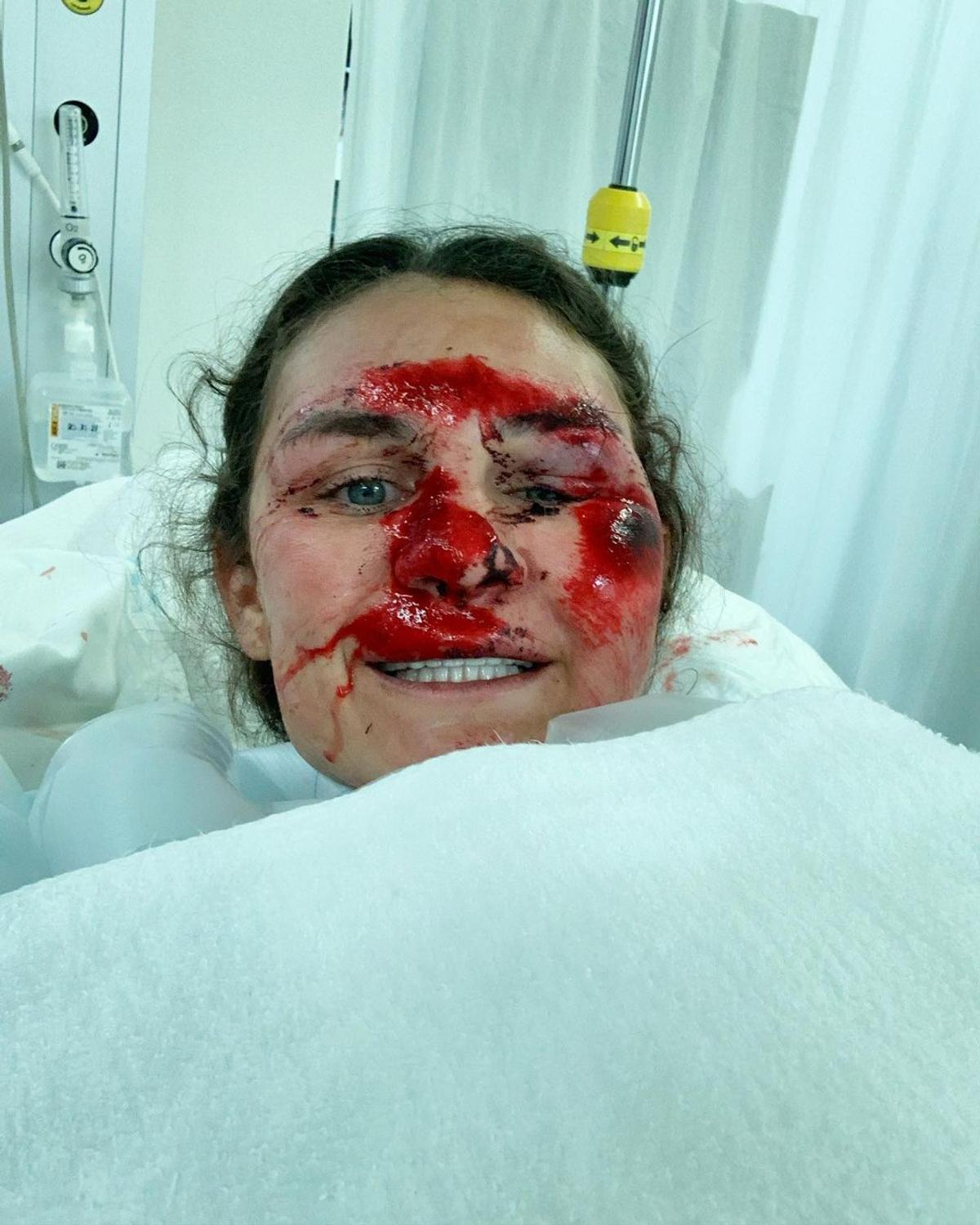 Vindecare în timp record » Cum arată acum Alice Merryweather, schioarea accidentată grav în urmă cu 3 săptămâni. Atenție, imagini dure!