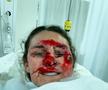 Vindecare în timp record » Cum arată acum Alice Merryweather, schioarea accidentată grav în urmă cu 3 săptămâni. Atenție, imagini dure!