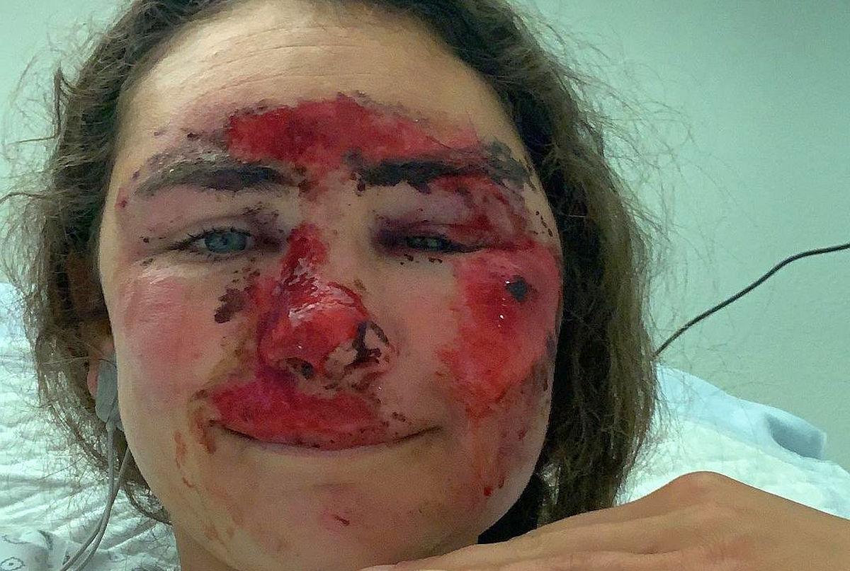 Vindecare în timp record » Cum arată acum Alice Merryweather, schioarea accidentată grav în urmă cu 3 săptămâni. Atenție, imagini dure!