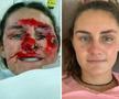 Vindecare în timp record » Cum arată acum Alice Merryweather, schioarea accidentată grav în urmă cu 3 săptămâni. Atenție, imagini dure!