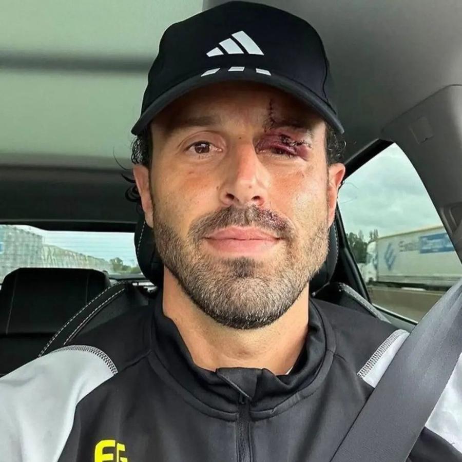 FOTO: Instagram @flash_gones Cum arată fața lui Fabio Grosso, a doua zi după ce a fost atacat cu pietre de ultrașii lui Marseille