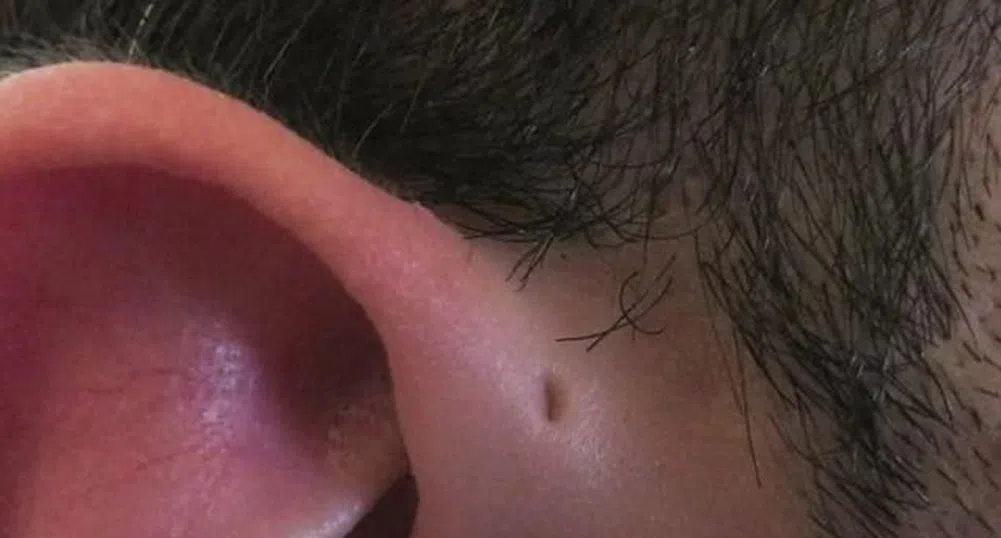 Защо някои хора имат дупка в горния край на ухото?