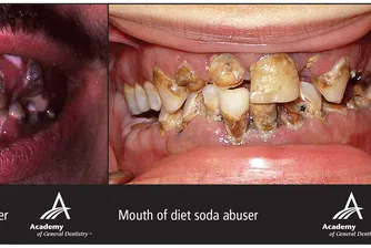 Вижте какво правят безалкохолните със зъбите ви!