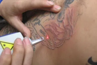 Премахването на татуировки – нов проспериращ бизнес
