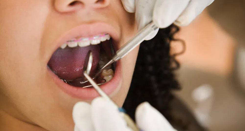 12 неща, които зъболекарят ще разбере, само като отвори устата ви