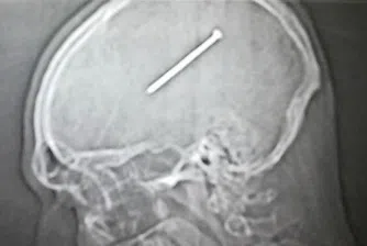 Мъж заби в черепа си 8 - сантиметров пирон, без да разбере