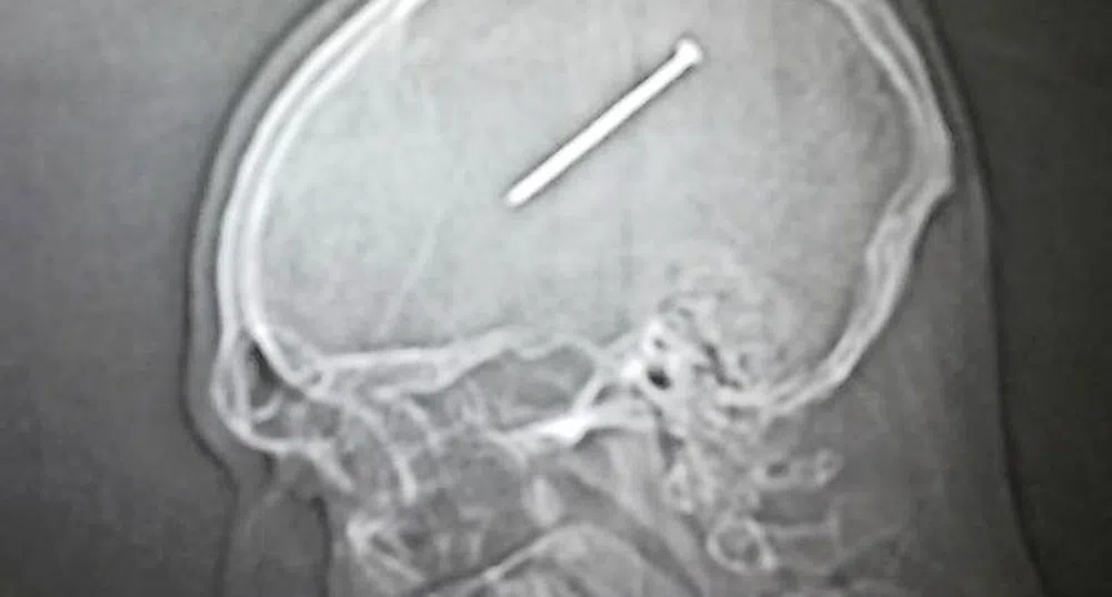 Мъж заби в черепа си 8 - сантиметров пирон, без да разбере