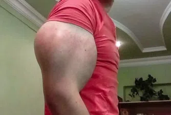 Руснак с 60-сантиметрови бицепси си инжектира опасни химикали