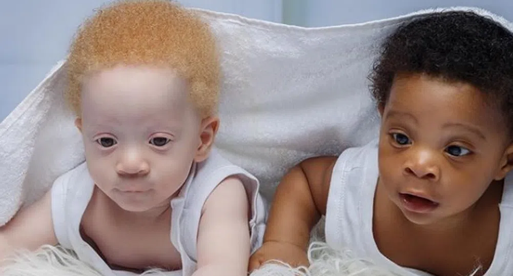 Близнаците Даниел и Дейвид, които имат различен цвят на кожата