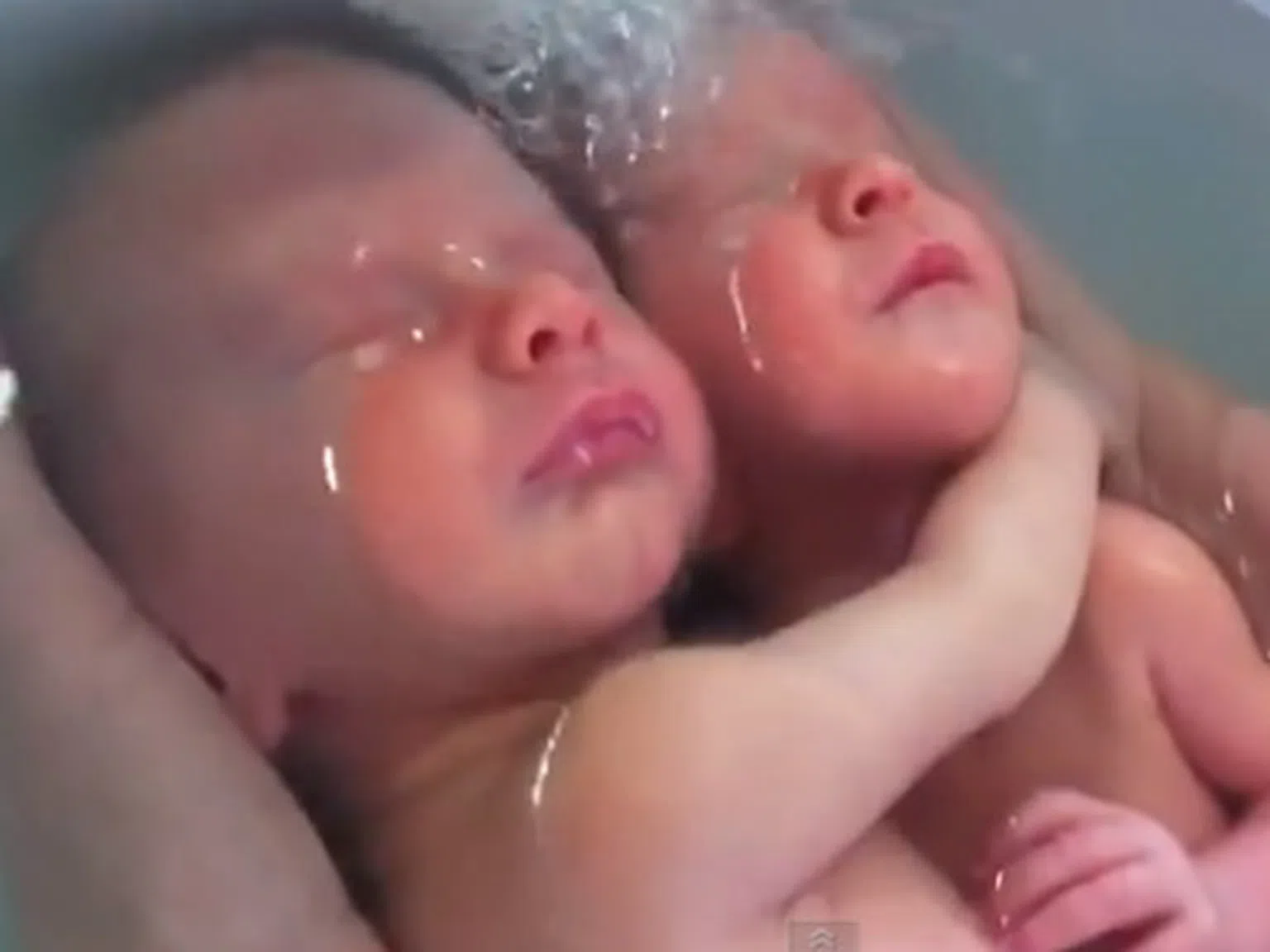 Близначета не знаят, че са се родили (видео)