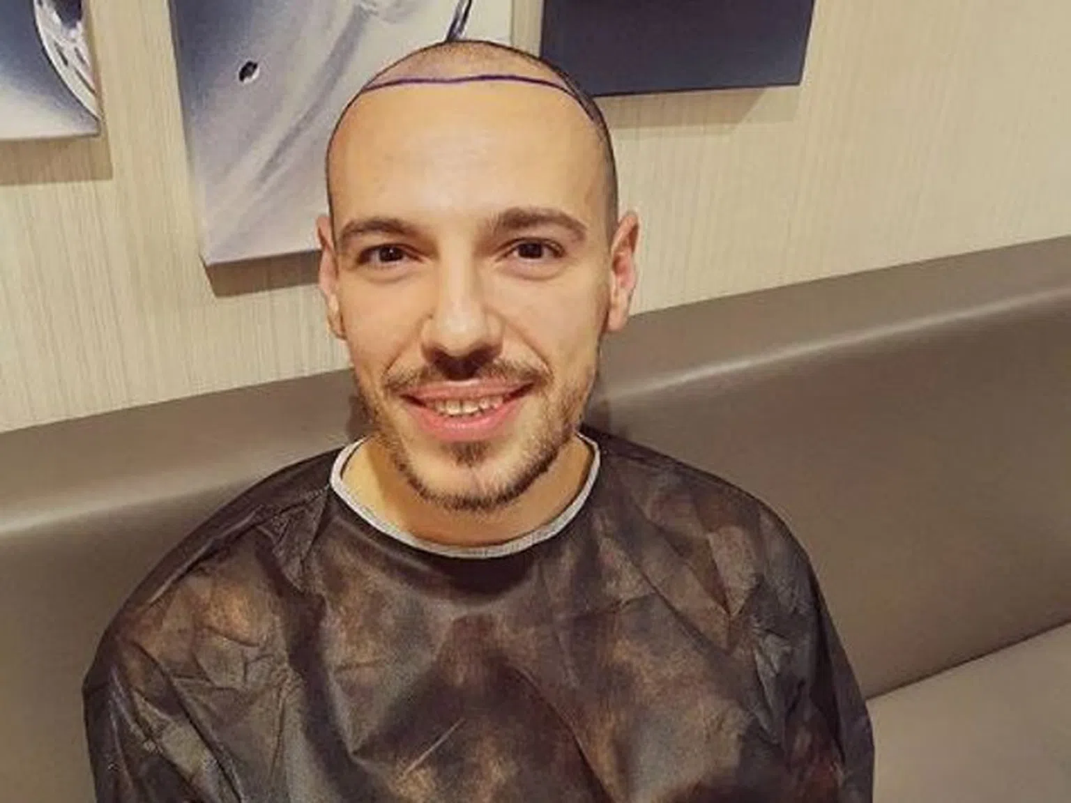 Даниел Петканов си присади коса на сметка
