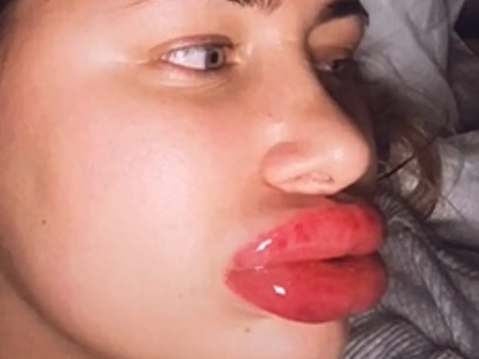 Истинска катастрофа: 23-годишна отиде да си увеличи устните, а се случи ето този ужас (видео)