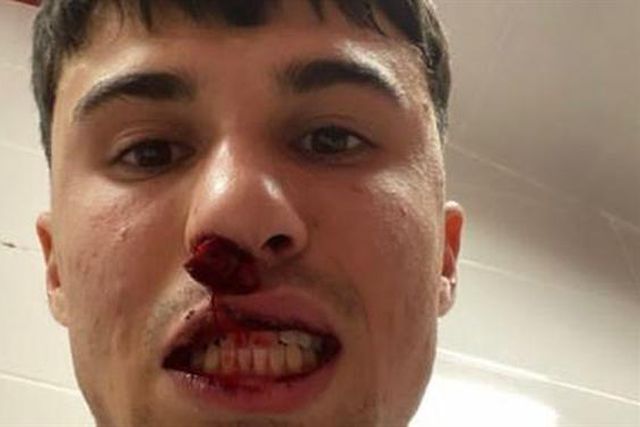 Surreal: adepto do Sivasspor invadiu relvado e partiu o nariz a jogador da Fiorentina!