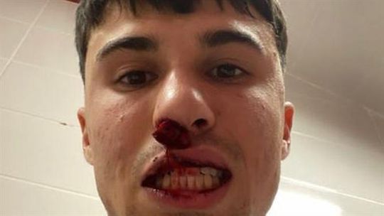 Surreal: adepto do Sivasspor invadiu relvado e partiu o nariz a jogador da Fiorentina!