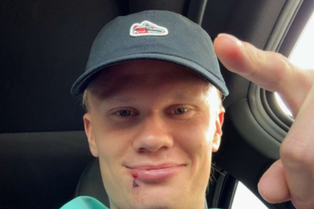 Haaland tem acidente e ganha três pontos na cara (fotos)