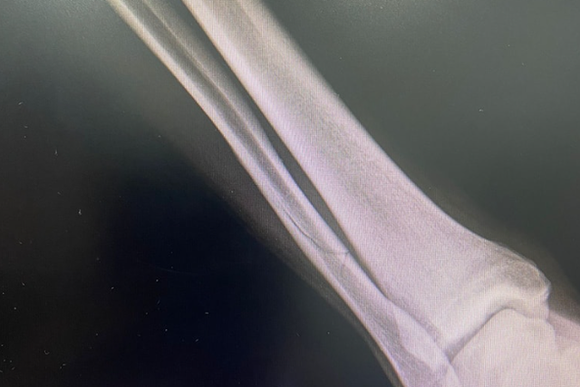 Jogador do Olivais e Moscavide parte perónio durante jogo